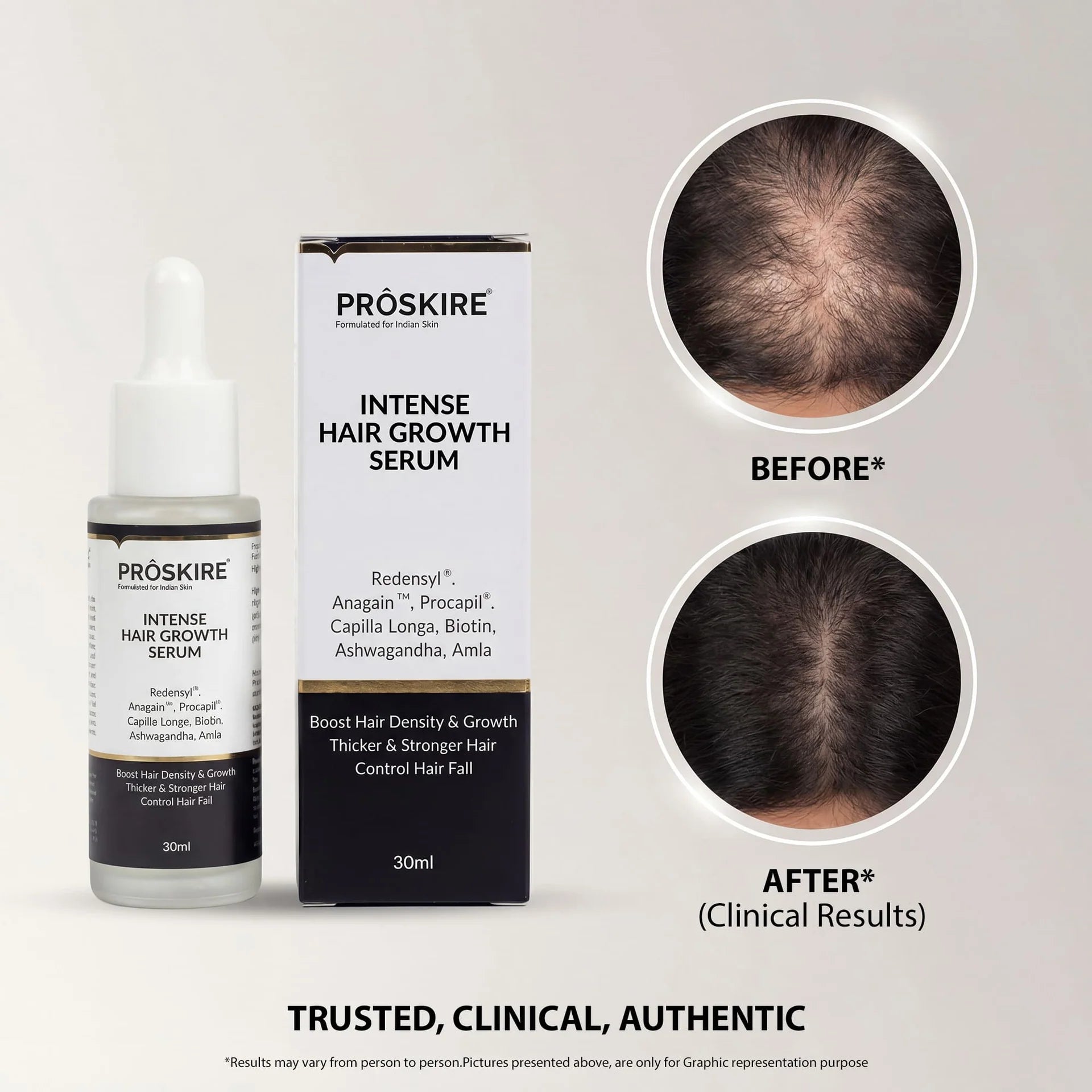 Before and after hair growth results with PROSKIRE Intense Hair Growth Serum showing healthier-looking, thicker, and fuller hair after consistent use.